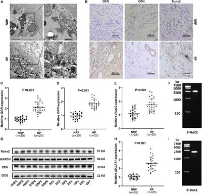 Osteogenic Differentiation of <mark class="highlighted">Renal Interstitial Fibroblasts</mark> Promoted by lncRNA MALAT1 May Partially Contribute to Randall’s Plaque Formation